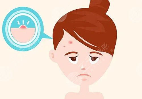 額頭長(zhǎng)了很多密密麻麻的小痘痘是什么原因？