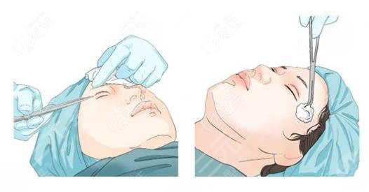 腫眼泡吸?脂一般價位是多少?
