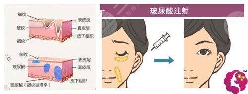 玻尿酸去法令紋需?要多少錢?