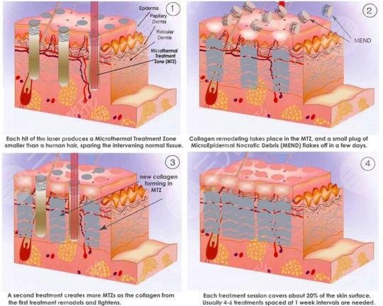 像素激光去痘疤?有用嗎?