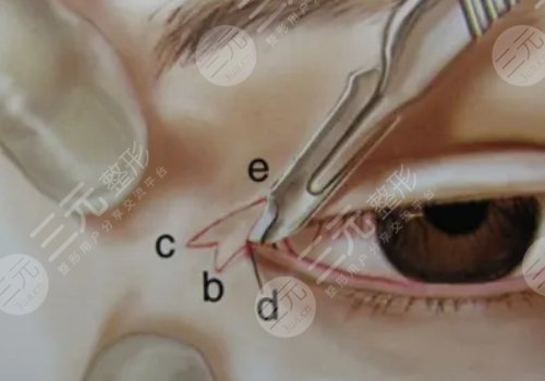 影響開內(nèi)眼角手術(shù)價(jià)格的因素有哪些?