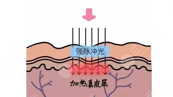 彩光嫩膚效果怎么樣?