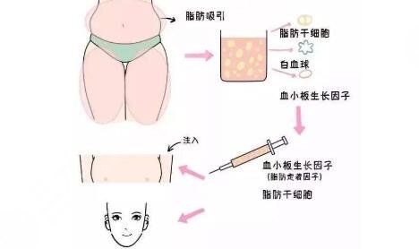 全臉脂肪填充怎么做呢？