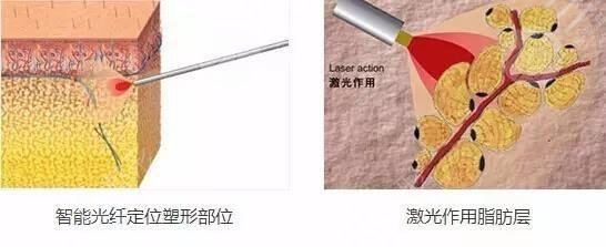 光纖溶脂瘦小腿怎么樣?