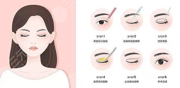 三點(diǎn)和歐式雙眼皮哪個(gè)好?看?