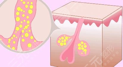 痘痘的形成原因有哪些?