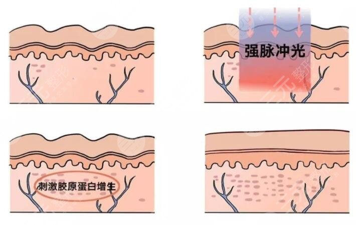 彩光嫩膚是什么原理