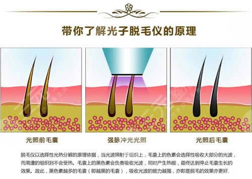 冰點(diǎn)脫毛和激光脫毛的區(qū)別