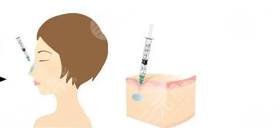 玻尿酸隆鼻會(huì)不會(huì)鼻梁越來越寬?