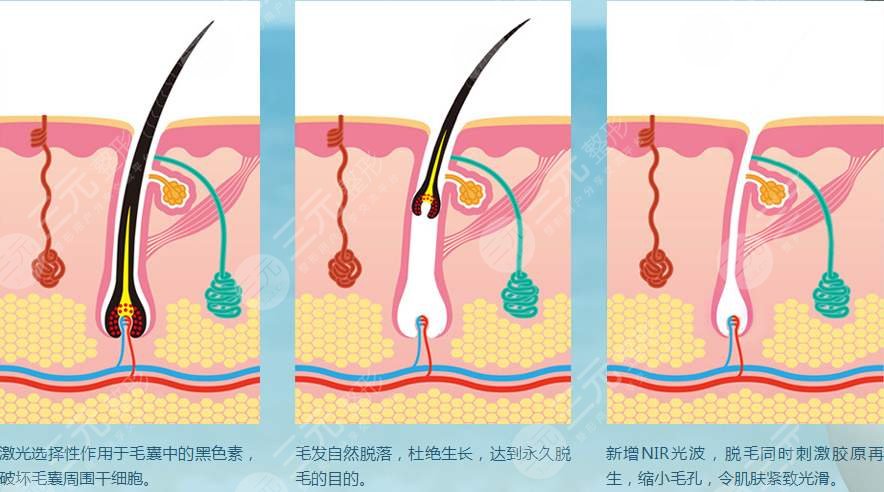 小腿激光脫毛的價(jià)格多?少?