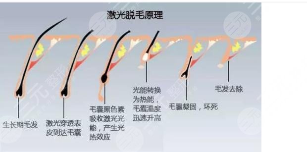 小腿激光脫毛的價(jià)格多?少?