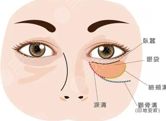 長(zhǎng)眼袋怎么消除?