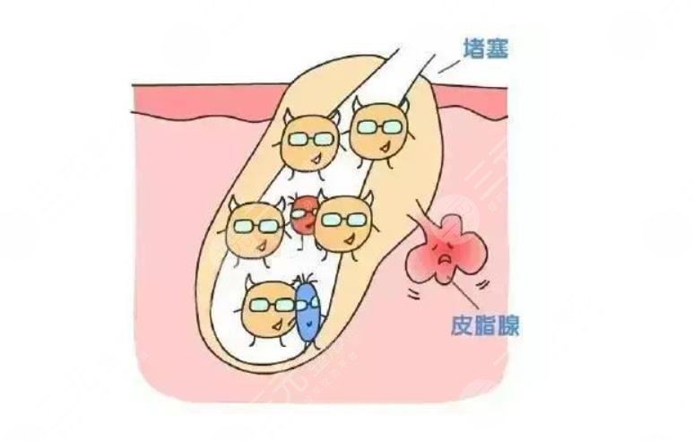 痘痘預防有哪些方法