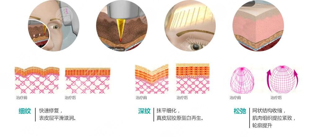 彩光嫩膚怎樣?好?處與功效有哪些?