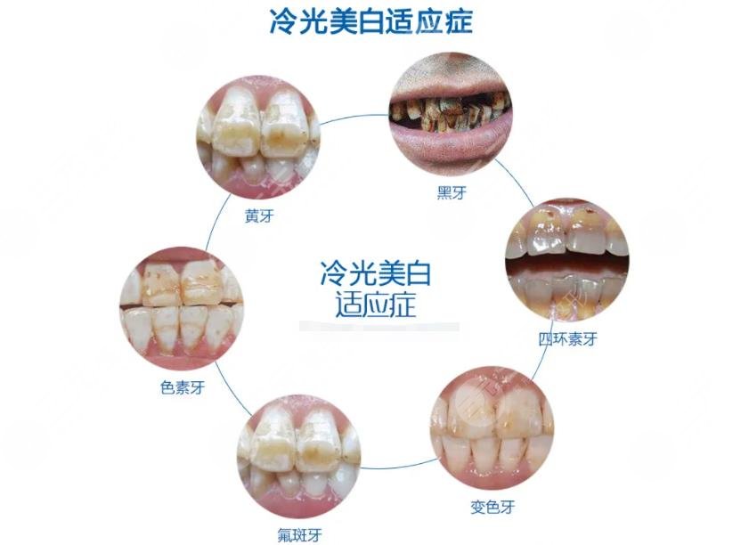 超聲波潔牙要多少錢(qián)一次?