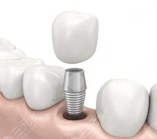 種植牙瑞士和瑞典的哪里的好？2種品牌優(yōu)劣勢(shì)深入分析，種植效果可以維持多久？