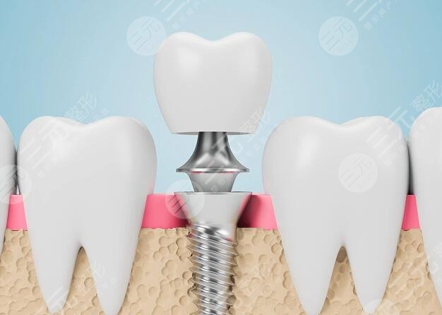 種植牙齒能用多少年?