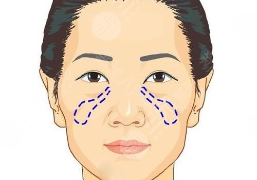 蘋果肌斷層是什么原因？