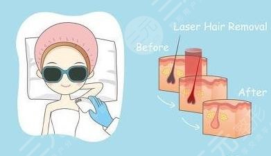 冰點脫毛的具體價?格曝光