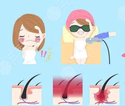 冰點脫毛的具體價?格曝光