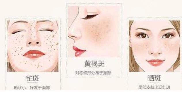 去除黃褐斑大概多少?錢(qián)?