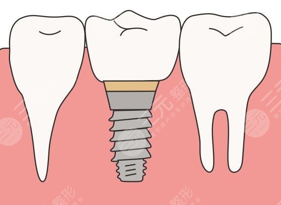 種牙材質都有哪些品牌好？涉及韓國、瑞士、瑞典等國進口品牌，怎么比較？