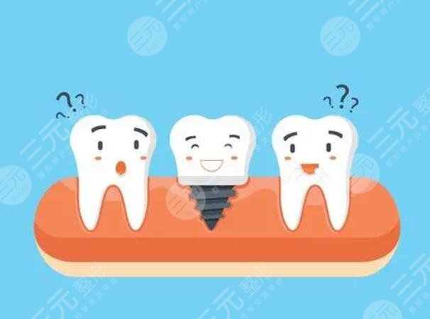 種牙材質都有哪些品牌好?