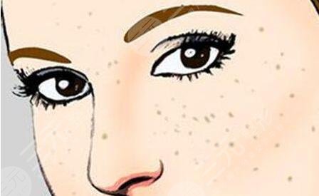 快速美白祛斑的注意事項(xiàng)