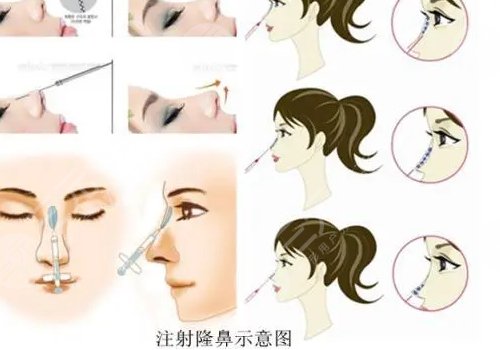 愛(ài)貝芙隆鼻會(huì)變寬嗎？