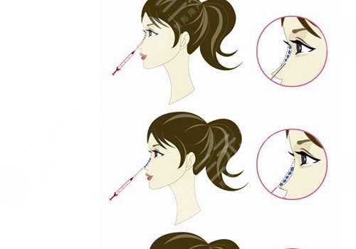 愛(ài)貝芙隆鼻會(huì)變寬嗎？