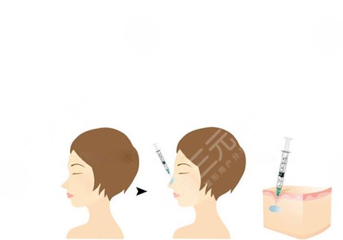 愛(ài)貝芙隆鼻會(huì)變寬嗎？