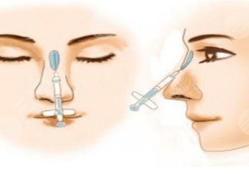 愛貝芙隆鼻會(huì)變寬嗎