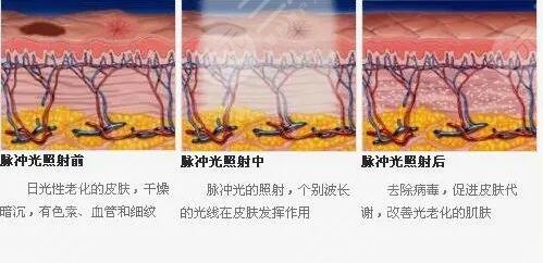 鐳射激光嫩膚后會(huì)反黑怎么辦?
