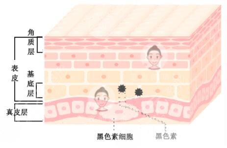 激光祛斑的注意事項
