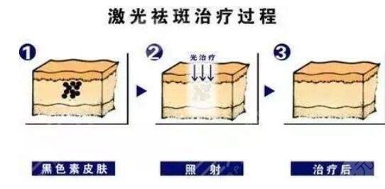 激光祛斑的注意事項