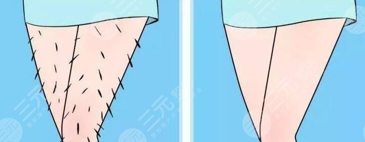 小腿激光脫毛的價格多少錢2023?