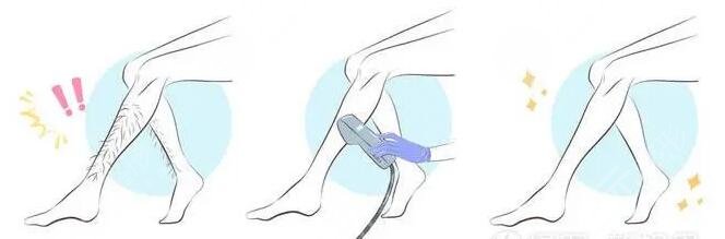 哪個季節(jié)適合激光脫毛?