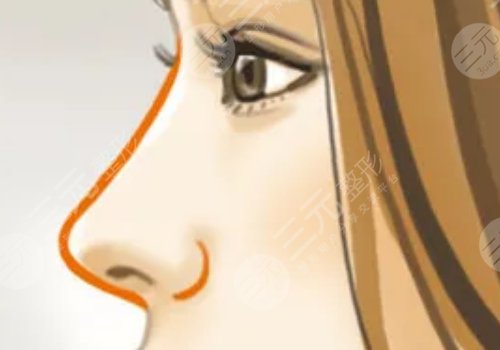 膠原蛋白隆鼻會變寬嗎？