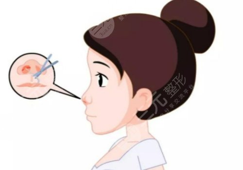 膠原蛋白隆鼻會變寬嗎？