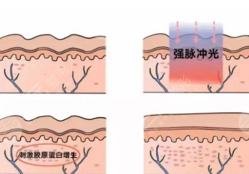 激光去疤痕需要幾次才能徹底消除？