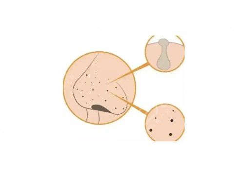 去黑頭收縮毛孔好的方法有哪些？