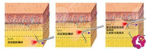 鐳射溶脂有效果嗎？