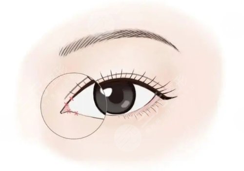 開內(nèi)眼角一般多少錢？