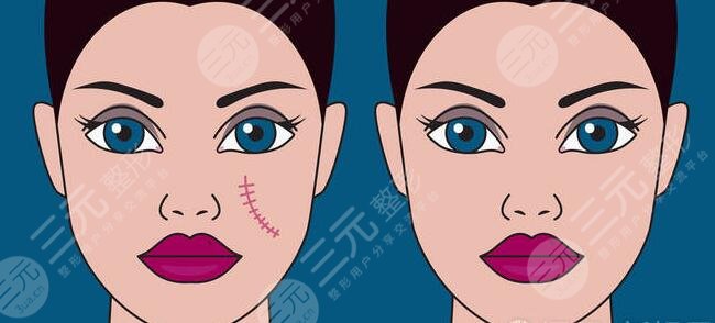 像素激光去疤效果怎么樣？要做多少次才行？技術優(yōu)點及是否安全？