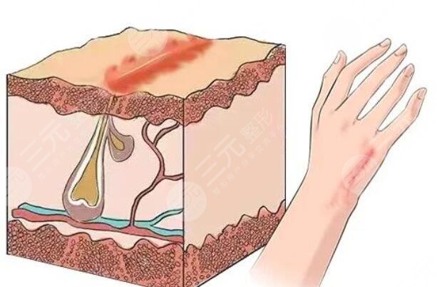 像素激光祛疤的優(yōu)點有哪些?