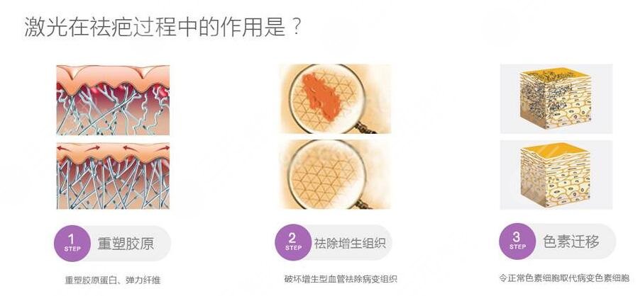 像素激光去疤的效果怎么樣?