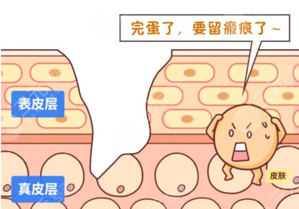 像素激光祛疤手術安全嗎?