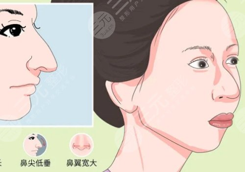 駝峰鼻矯正手術(shù)多少錢？