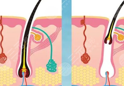 激光脫毛和冰點(diǎn)脫毛哪個(gè)好？