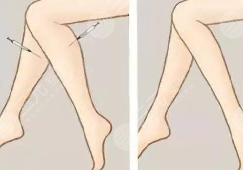 小腿吸脂后多久可以正常走路？
